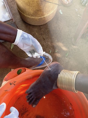 A worm is carefully extracted from a person’s foot in Ethiopia.